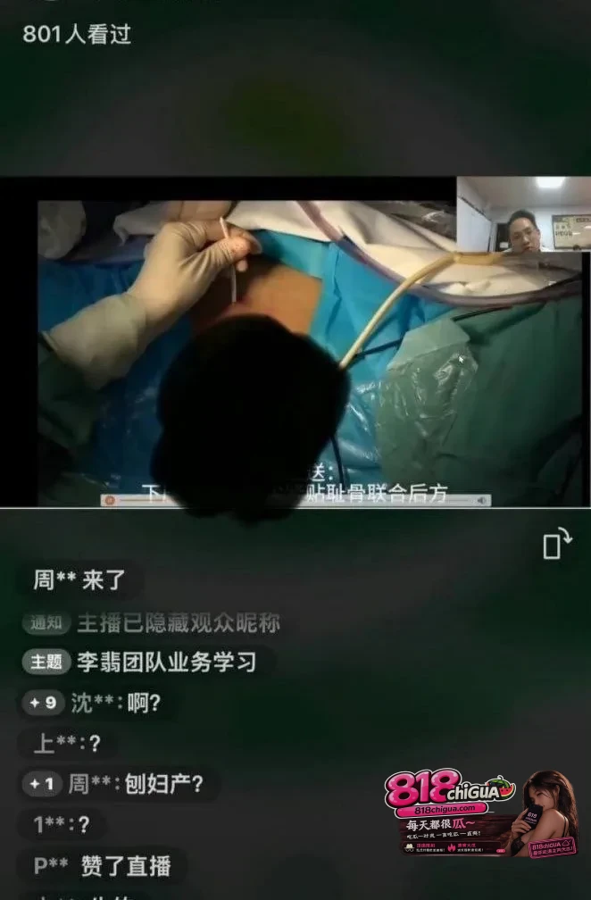 产科手术完整视频曝光!山西医科大学第一医院实习护士晒产科手术暴露女患者隐私部位,引爆全网围观。